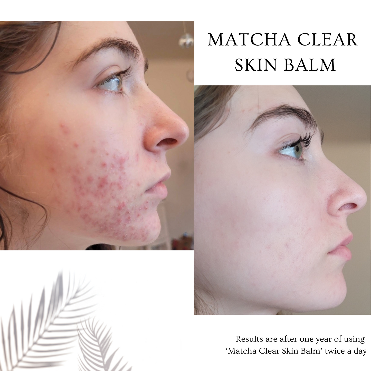 before pic of girl with acne and after pic of same girl with clear skin from using the Matcha Clear Skin Balm